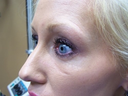 woman's eyes rejuvenated after blepharoplasty eyelid surgery