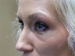 woman’s eyes before blepharoplasty eyelid surgery