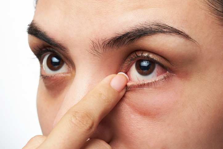 close up of woman show her red sick eye with finger