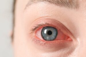 A close-up shot of a woman's red eye caused by allergies or dry eye syndrome