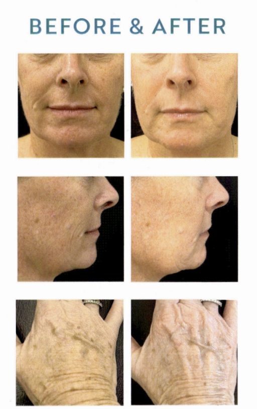 Before and After Results