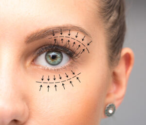 Diagram shows plan on woman's eye ahead of oculoplastic surgery.