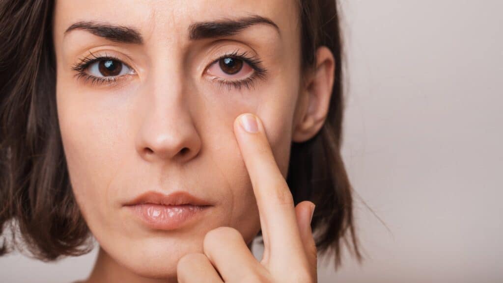 Woman has red, irritated eye after suffering from chronic dry eye. Woman has red, irritated eye after suffering from chronic dry eye.